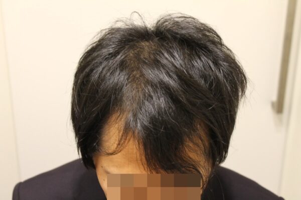 【診察3回目】AGA治療2ヶ月目（前髪）
