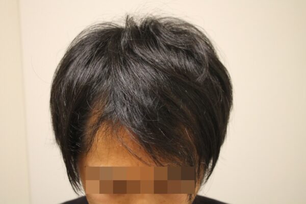 【診察4回目】AGA治療3ヶ月目（前髪）