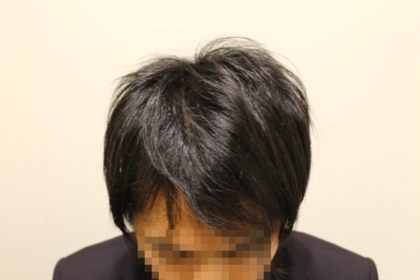 【診察5回目】AGA治療4ヶ月目（前髪）