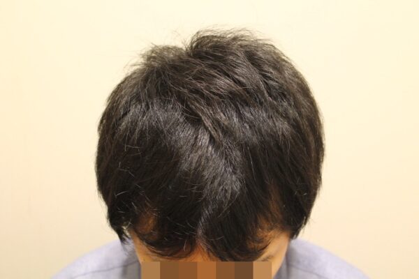 【診察6回目】AGA治療6ヶ月目（前髪）
