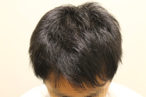 【診察8回目】AGA治療12ヶ月目（前髪）